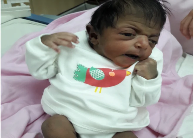 Craniosynostosis: A Case of Brachycephaly and Suspected Crouzon Syndrome in a Newborn